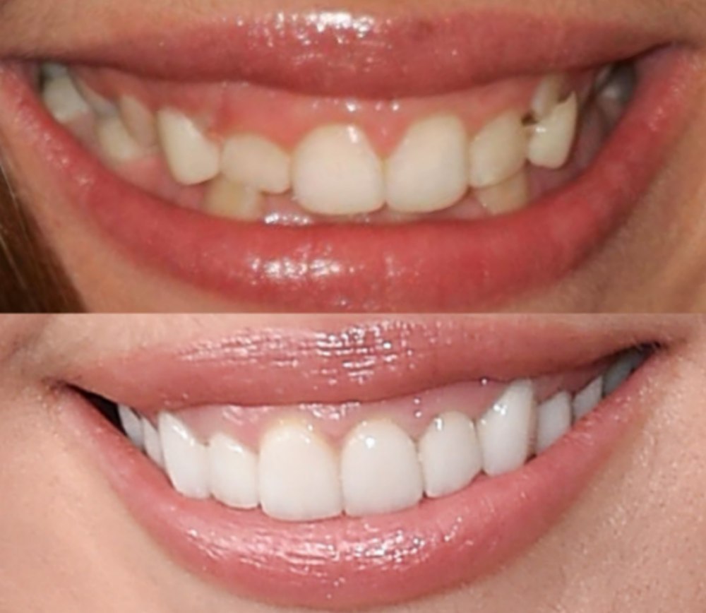 Miley Cyrus smile transformation